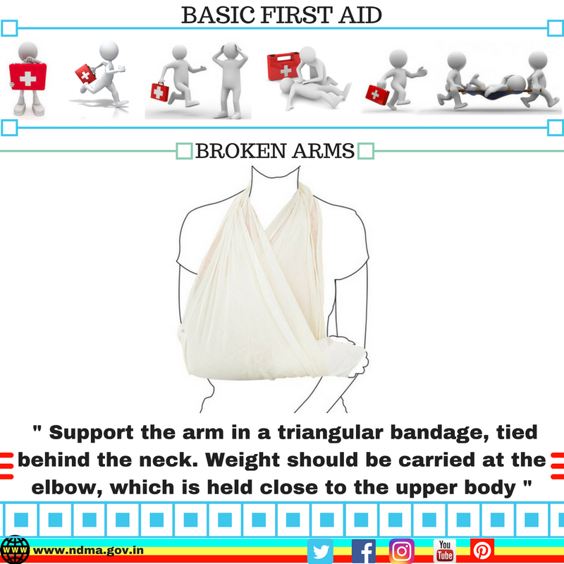 Support the arm in a triangular bandage, tied behind the neck. Weight should be carried at the elbow, which is held close to the upper body